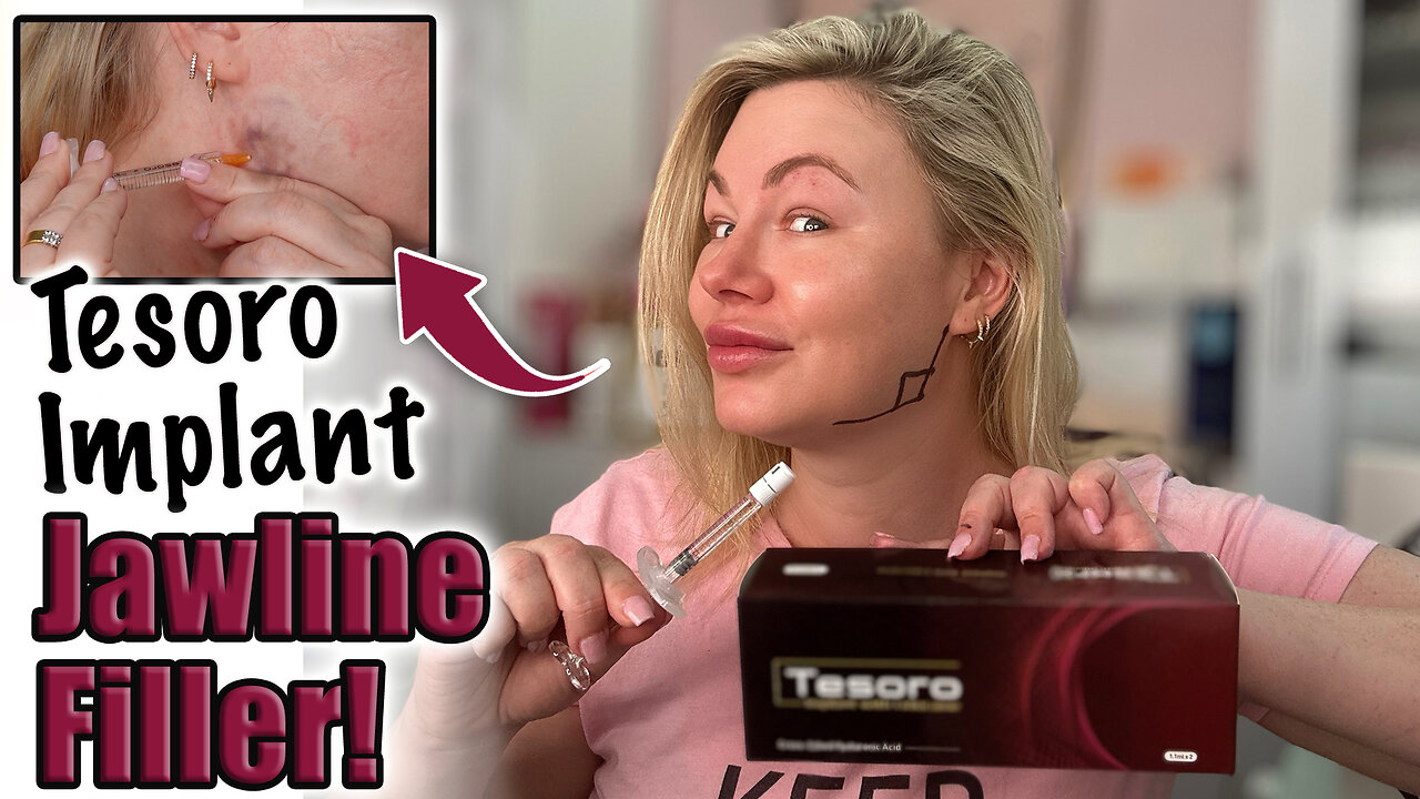 Tesoro Implant Jawline Filler at Home! AceCosm.com and code Jessica10 Saves you Money