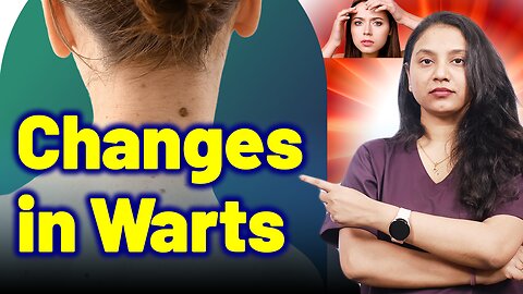 Body Changes in Warts | Treatment and Cure | Homeopathy, Medicine & Surgery