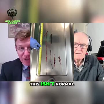 A Global Survey of Embalmers in 2024 has revealed a starting trend💉💀... White Fibrous Blood Clots