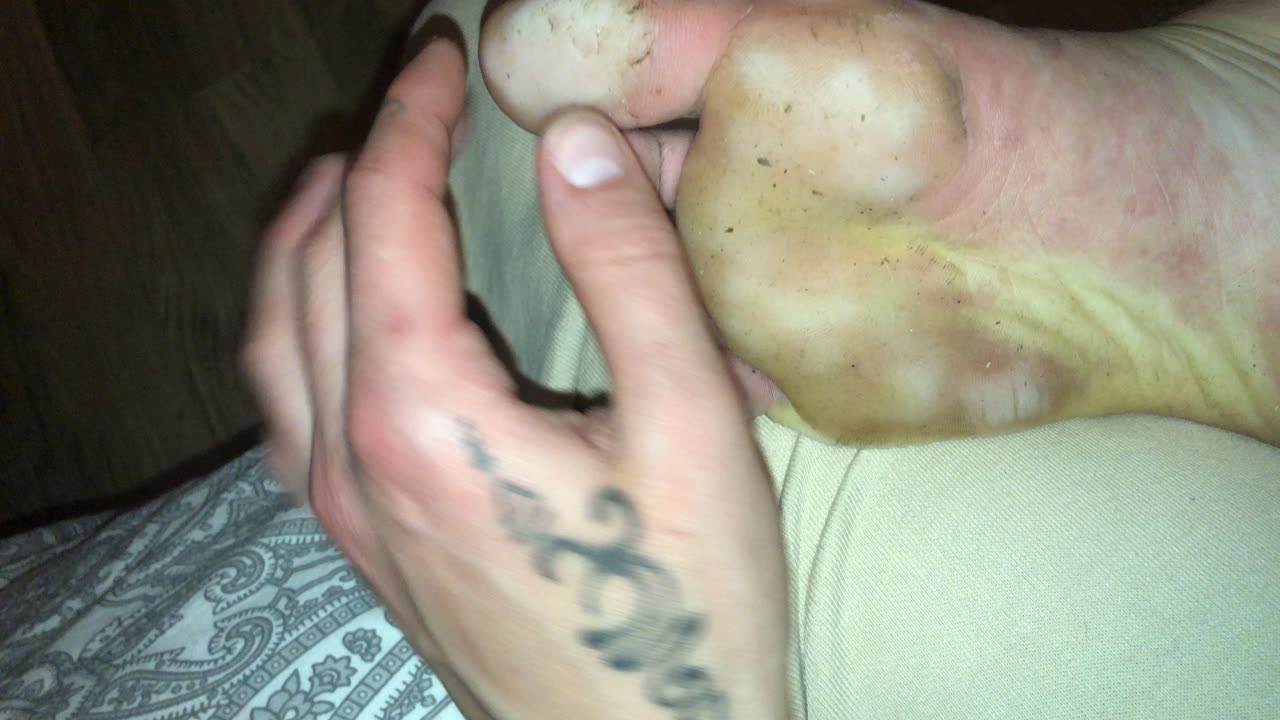 This is how my feet looked after wearing shoes