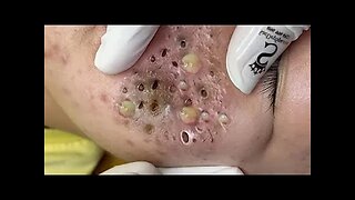 Relaxing Blackheads Removal Big Cystic Acne Extraction Whiteheads Pimple Popping 01