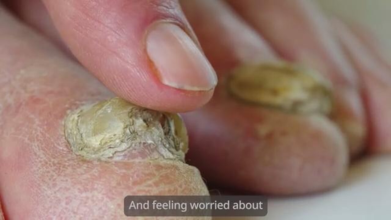 Foot Fungus ? I Wore A Silver Ring On My Toe & This Happened