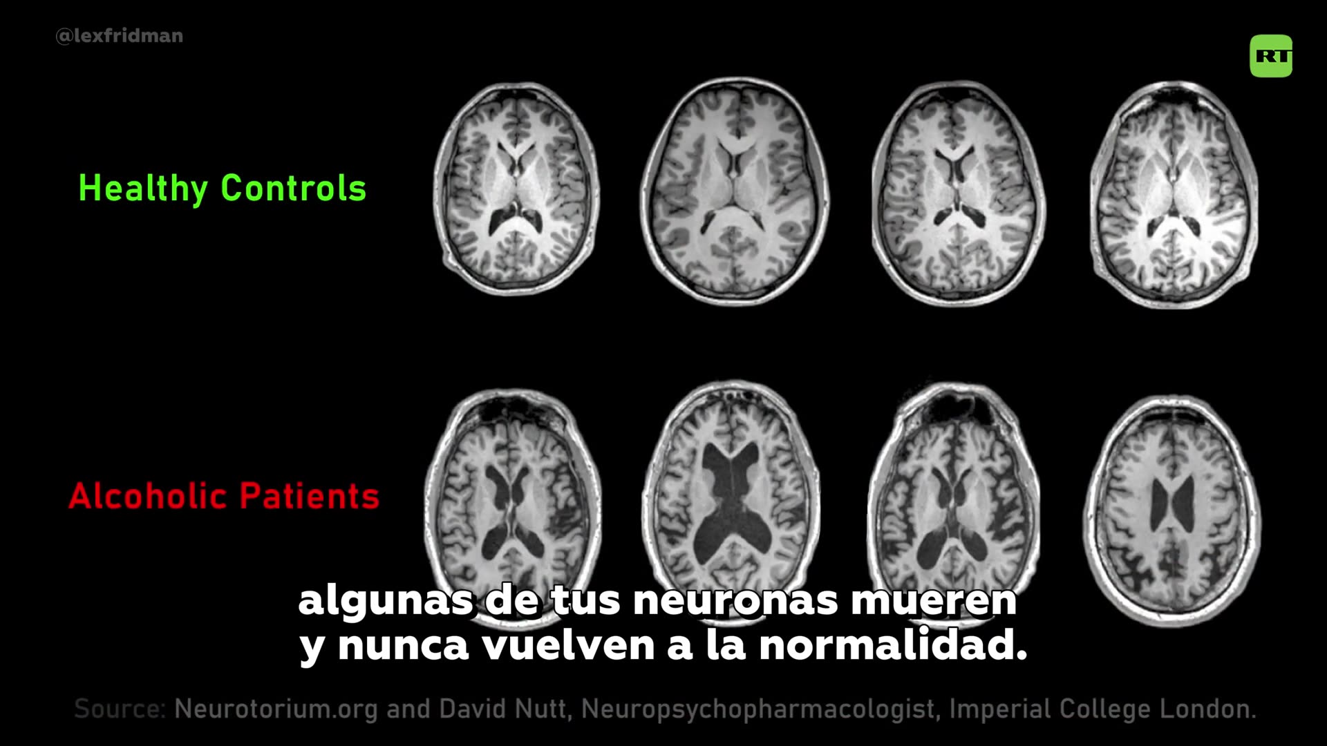 ⁉️¿El alcohol convierte en "zombis" a tus neuronas?
