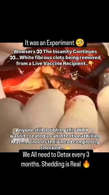 Blood clots he removed during surgery were caused by the COVID vaccine