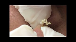 Satisfying blackhead removal and Pimplepopping 8875