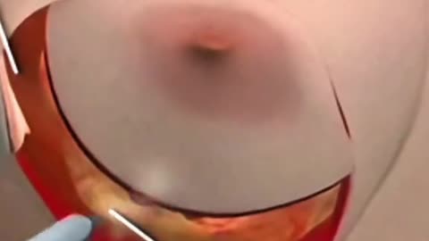 Breast Cancer Removal Surgery Explained, Life-Saving Procedure Awareness