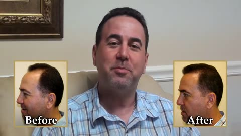 Transformative Hair Transplant with Dr. Brett Bolton