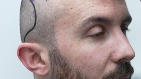 DHI is ideal for natural hairlines, dense results, and unshaven procedures.