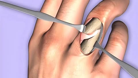 Broken Finger Plating Surgery, How Doctors Fix Fractured Fingers