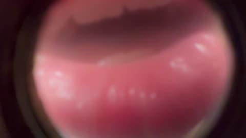 Fish eyelens treatment for you