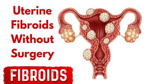 how to get rid of uterine fibroids