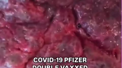 Plazenta nach 2facher C-Impfung | Double vaxxed Placenta during pregnancy!