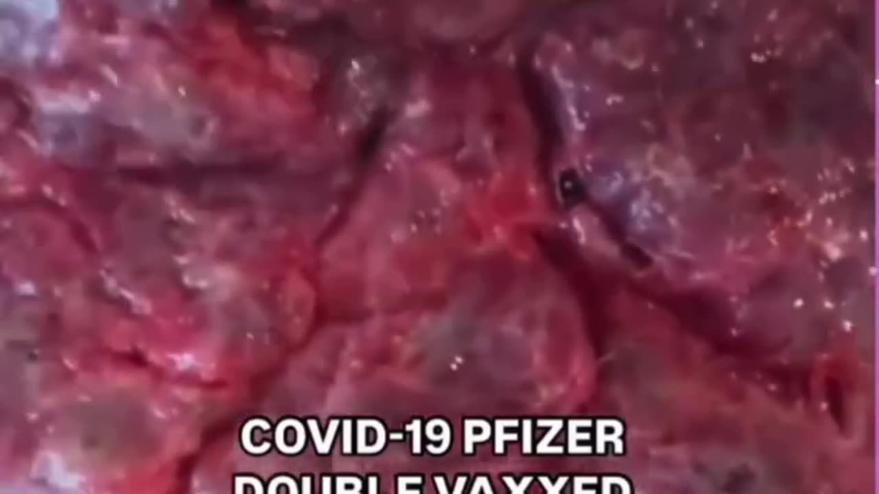 Plazenta nach 2facher C-Impfung | Double vaxxed Placenta during pregnancy!