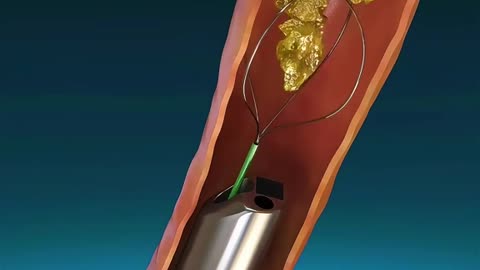 Ureteroscopy Procedure (3D Animation)