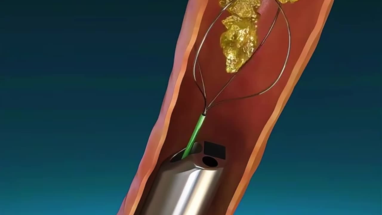 Ureteroscopy Procedure (3D Animation)