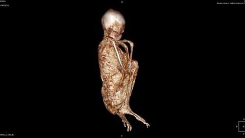 🚨👽 New Medical Scan of Antonio Released: What Does It Reveal? | TheTruthAbove