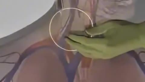 Jugular Vein Cannula Insertion Procedure - Step-by-Step Medical Guide