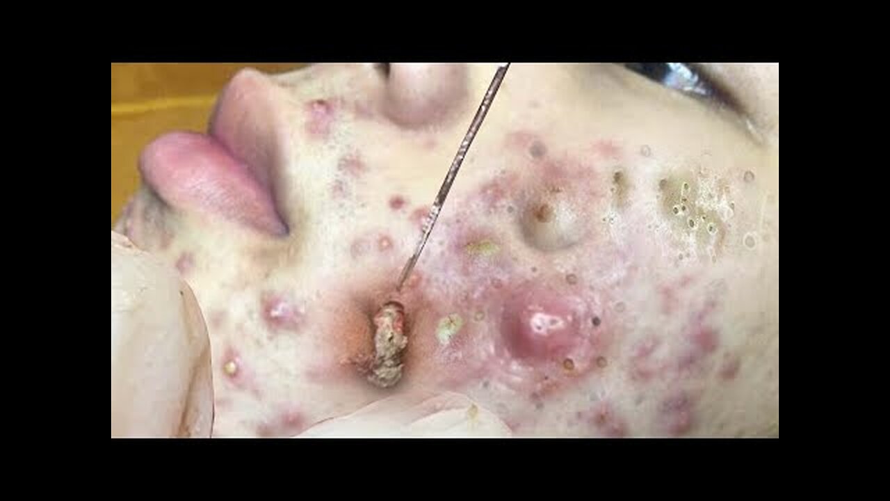 Satisfying blackhead removal and Pimplepopping Spa relaxation