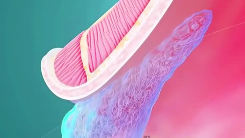 Laser Hemorrhoidectomy Procedure (3D Animation)
