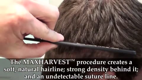 Dr. Brett Bolton Delivers Truly Undetectable, Scarless Hair Transplants