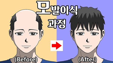 Hair transplantation - Animation