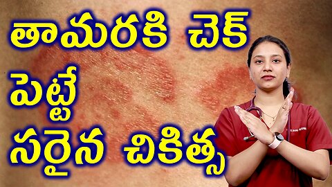 తామరకి చెక్ పెట్టే సరైన చికిత్స Advantages of Best homeopathy Treatment for Tinea or Ringworm Cure
