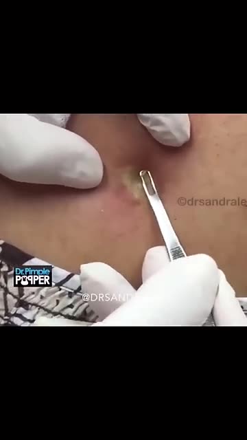 The gift that kept on giving A NonStop Pop by Dr Pimple Popper ️️