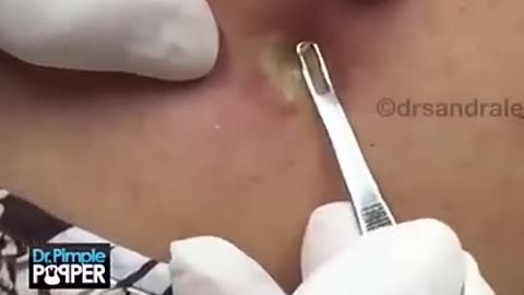 The gift that kept on giving A NonStop Pop by Dr Pimple Popper ️️