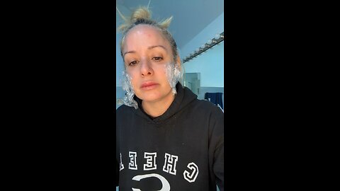 PDO MONO 3028 in cheeks