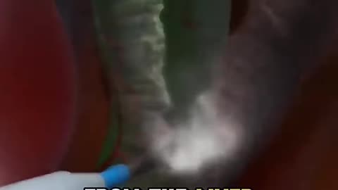 Gallblader Removal Surgery Procedure