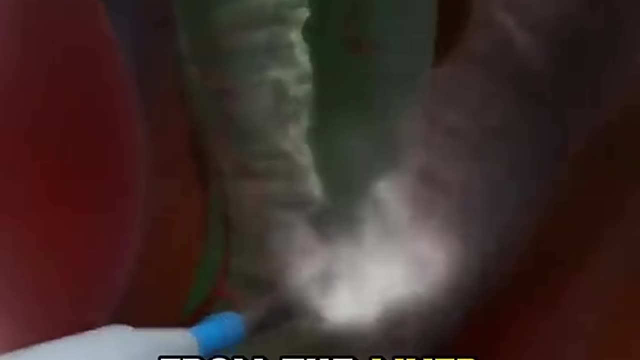 Gallblader Removal Surgery Procedure