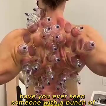 Why Is His Back Covered in Glass Cups? Ancient Healing Technique Revealed!