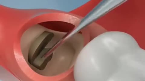 Wisdom Teeth Extraction 3D Animation