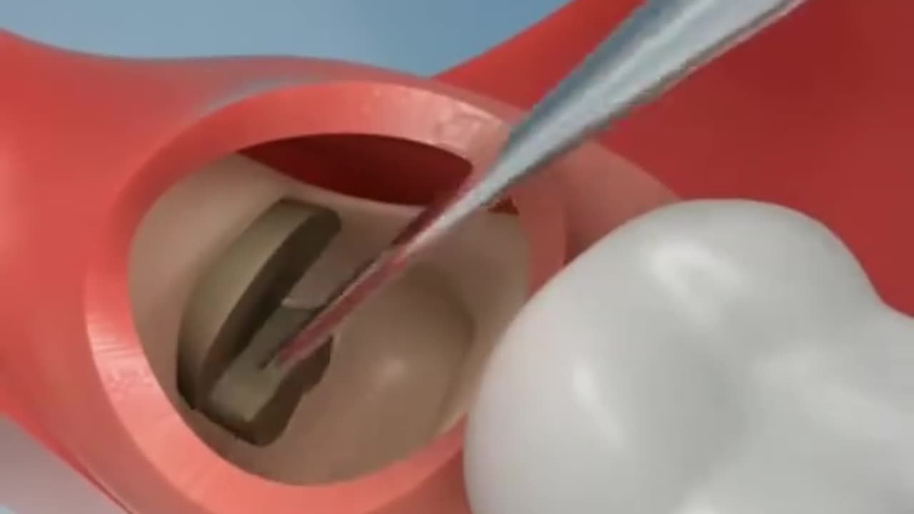 Wisdom Teeth Extraction 3D Animation