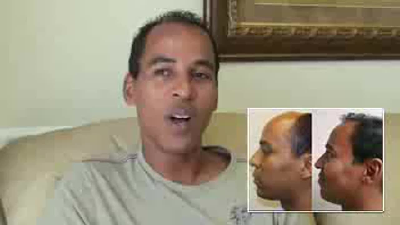 Another Happy Patient After Dr. Brett Bolton’s MaxHarvest™ Procedure