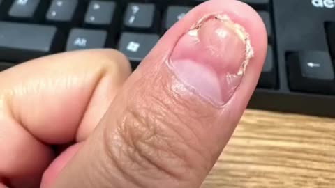 🧬⏳ Nail Regrowth Time-Lapse! Watch It Grow Back Fast | FeedMyCuriosity