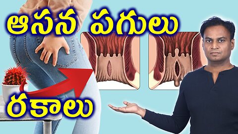 ఆసన పగుళ్లు ఎన్ని రకాలు? | Types Of Anal Fissure | Rectal Tear Homeopathy Treatment Cure Medicine