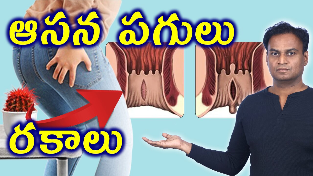 ఆసన పగుళ్లు ఎన్ని రకాలు? | Types Of Anal Fissure | Rectal Tear Homeopathy Treatment Cure Medicine