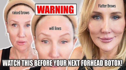WARNING! Before Your Next Forehead Botox Watch This - Pros and cons of Forehead Botox!! #botox