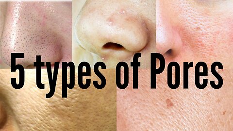 5 Types of Pores