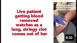 Live patient getting blood removed watches as a long, stringy clot comes out of her