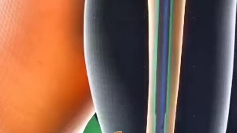 Tibia Lengthening Surgery Advanced Orthopedic Procedure Explained