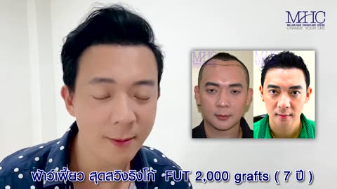 Million Hair transplant Center, Bangkok, Thailand FUE FUT