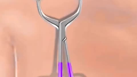 Clavicle Bone Plating Surgery Broken Collarbone Treatment Explained