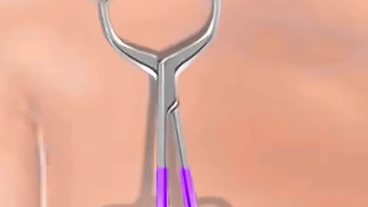 Clavicle Bone Plating Surgery Broken Collarbone Treatment Explained