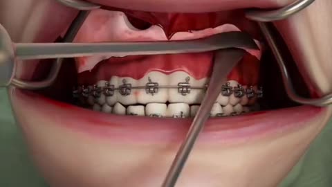 Maxillary Osteotomy Procedure 3D Abimation