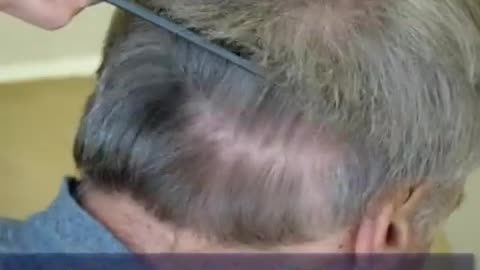 Dr. Brett Bolton Delivers Amazing Hair Transplant Results