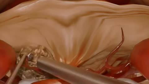 Tumor (Meningioma) In The Skull