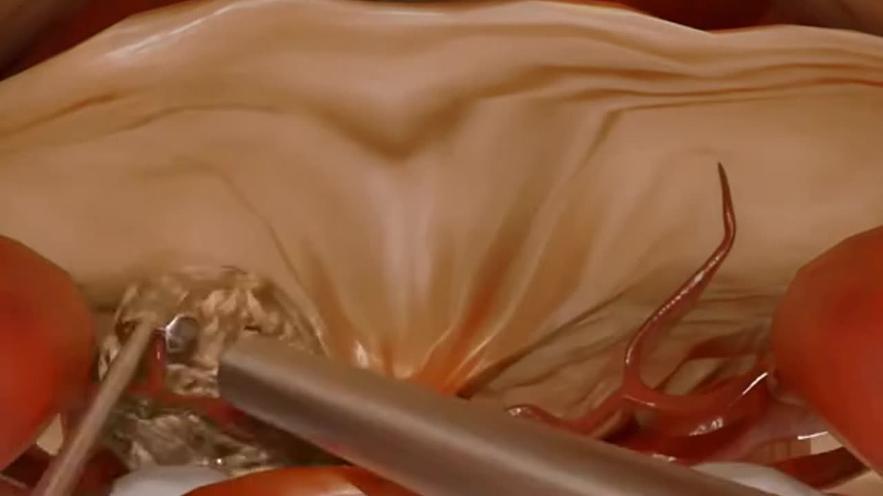 Tumor (Meningioma) In The Skull