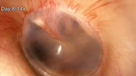 Ear Infection With Drainage Timelapse 3D Animation